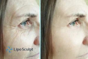 How to Fight Aging Symptoms 2 Do you want to Fight Aging Symptoms Diss? Contact Lipo Sculpt today!