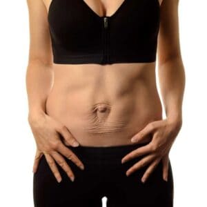 EM Tone Sculpt : A Game-Changer in Non-Surgical Diastasis Recti Muscle Repair 3 diastasis Recti treatment