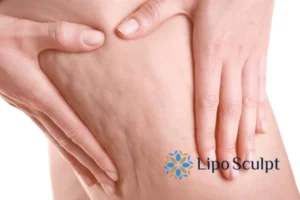 CoolSculpting for Legs: The Innovative Approach to Redefining Your Legs 5 Start your journey today book your coolsculpting treatment Diss online today!